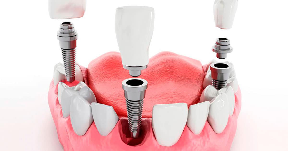 Классическая имплантация зубов