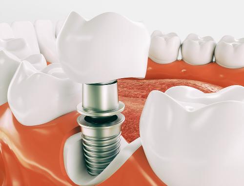 Преимущества и недостатки имплантации зубов