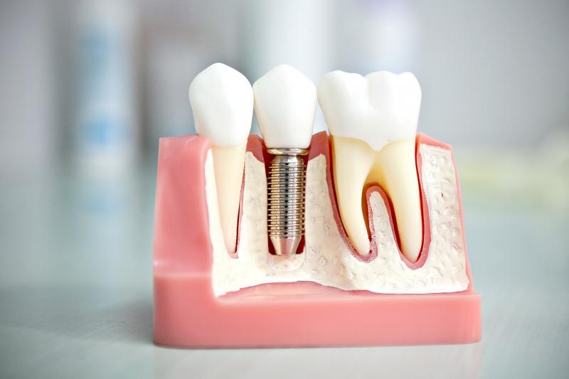 Какие существуют противопоказания к имплантации зубов
