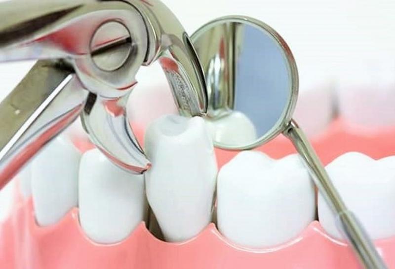 Удаление зуба: особенности и основные этапы процедуры